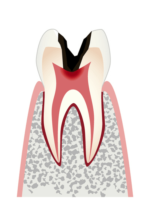 歯髄＝歯の神経まで達した虫歯