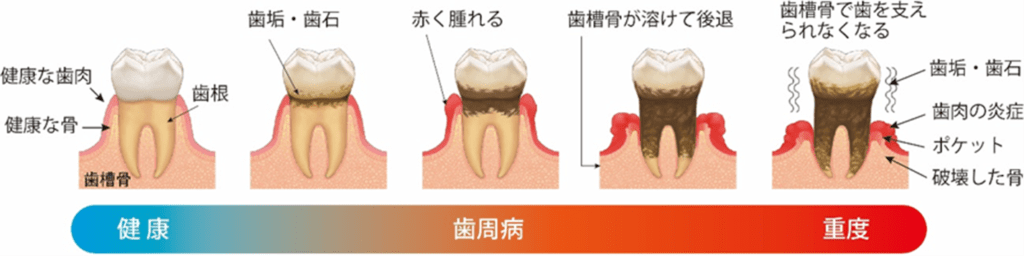 歯周病の進行症状と治療方法